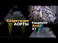 Коарктация аорты в 30+. Роды с коарктацией аорты. Кардиолог. ЭхоКГ -как не пропустить коарктацию. КТ