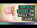 The REAL Causes of VERTICAL RIDGES On Your Nails