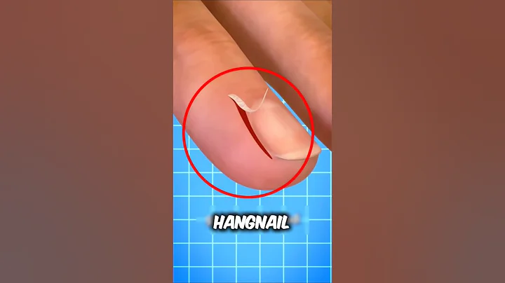 OMG😱‼️this could be happened to you if you peel your hangnail.😱😭‼️