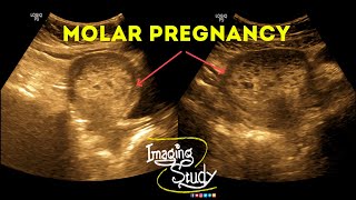 Molar Pregnancy || Hydatidiform Mole || Gestational Trophoblastic Disease || Ultrasound || Case 38