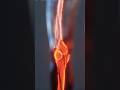 Did You Know Your Bones Are Stronger Than Steel?