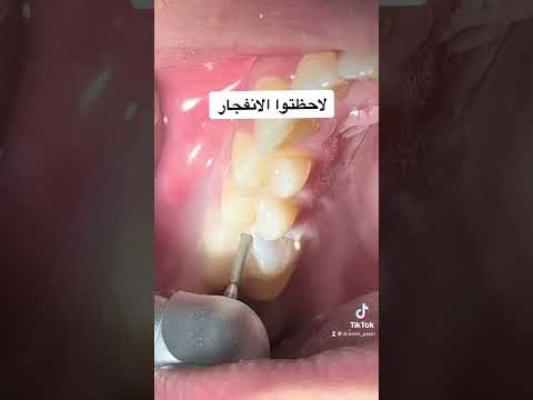 إزالة التسوس