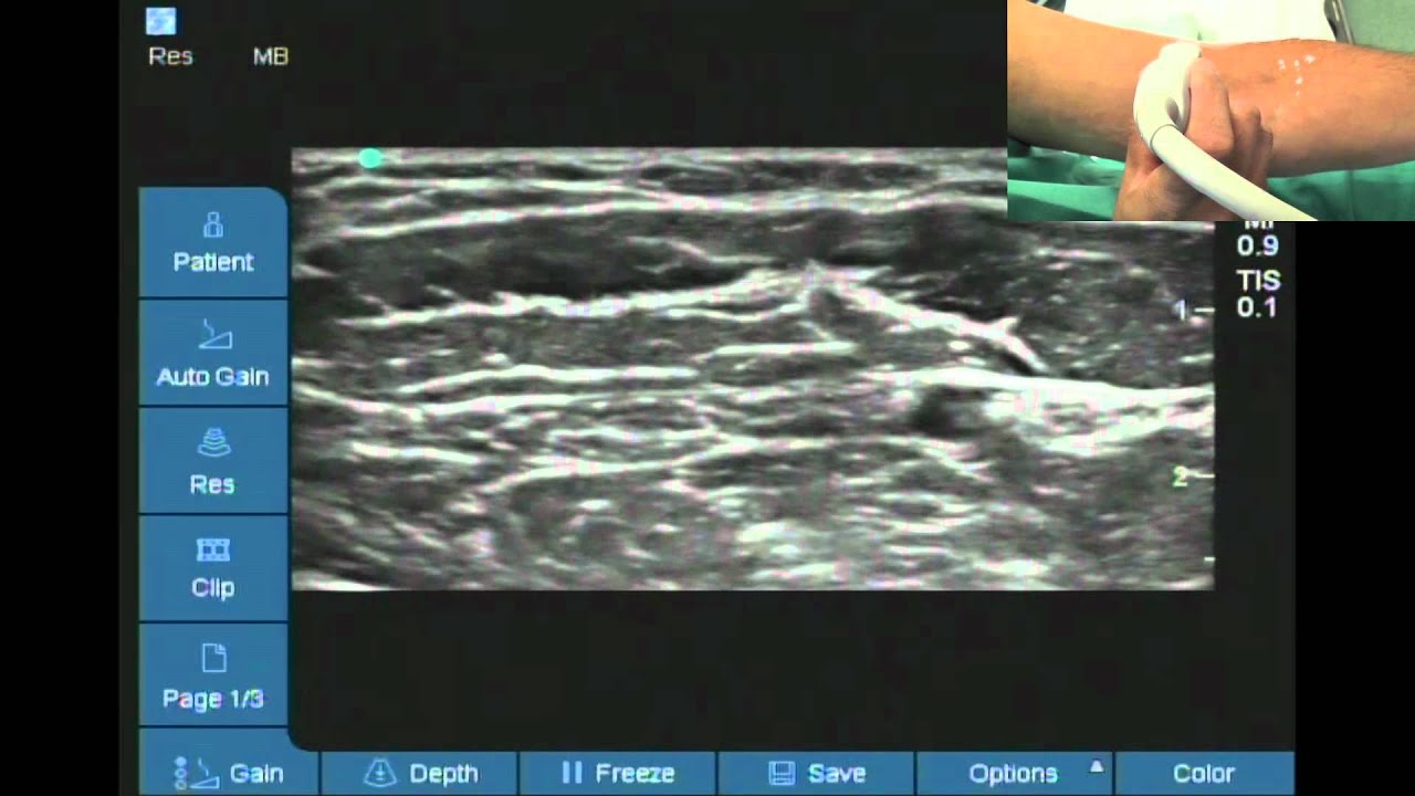 Ultrasound location of Lateral cutaneous nerve of forearm - YouTube