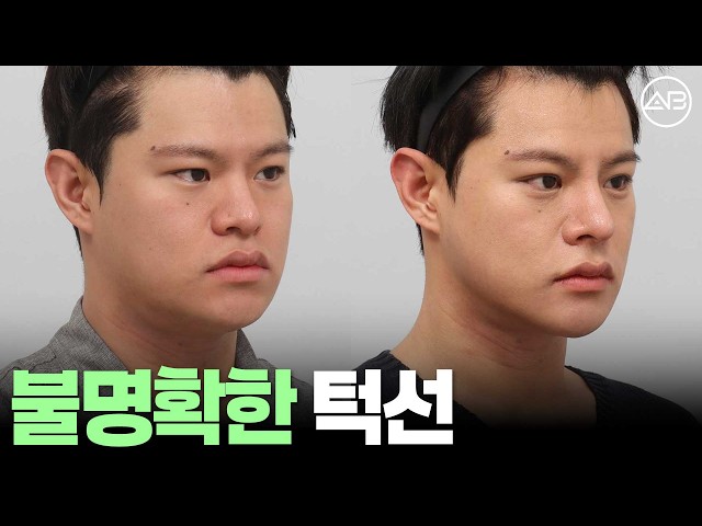 윤곽수술로 불명확한 턱선 살리기 성공 | 후기있음 | 에이비성형외과