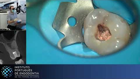 Rtx of 🦷26 with Missed Anatomy | AAP ▶️ Single Session | CASE299