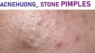 Acne Treatment Huong Da Nang# _ 2024  #acne_606#Stone Acne