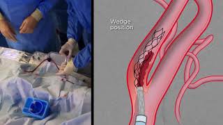Extracranial Thrombectomy with eSAVE