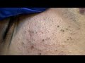 [ASMR] Daily Skincare Routine for Clear Skin, Blackhead Removal and Deep Pore Cleansing