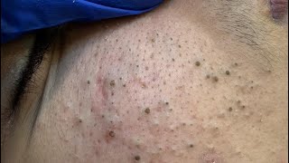 [ASMR] Daily Skincare Routine for Clear Skin, Blackhead Removal and Deep Pore Cleansing