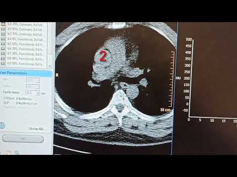 CT Coronary أشعة مقطعية علي شرايين القلب (Cardic Angio Graphy)