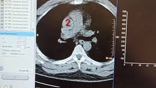 CT Coronary أشعة مقطعية علي شرايين القلب (Cardic Angio Graphy)