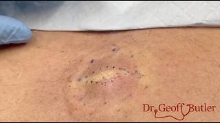 Removal of a large Epidermal cyst on the back