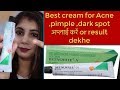 Batnovate N cream review !! suhanigupta