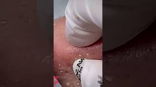 Acne Treatment & Blackhead Removal | Very Satisfying Pimple Popping #099