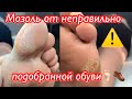 Мозоль от неправильно подобранной обуви🦶🏻👞⚠️