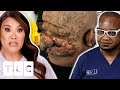 Dr. Lee Needs An Expert's Help To Remove The Bumps On This Man's Head | Dr. Pimple Popper