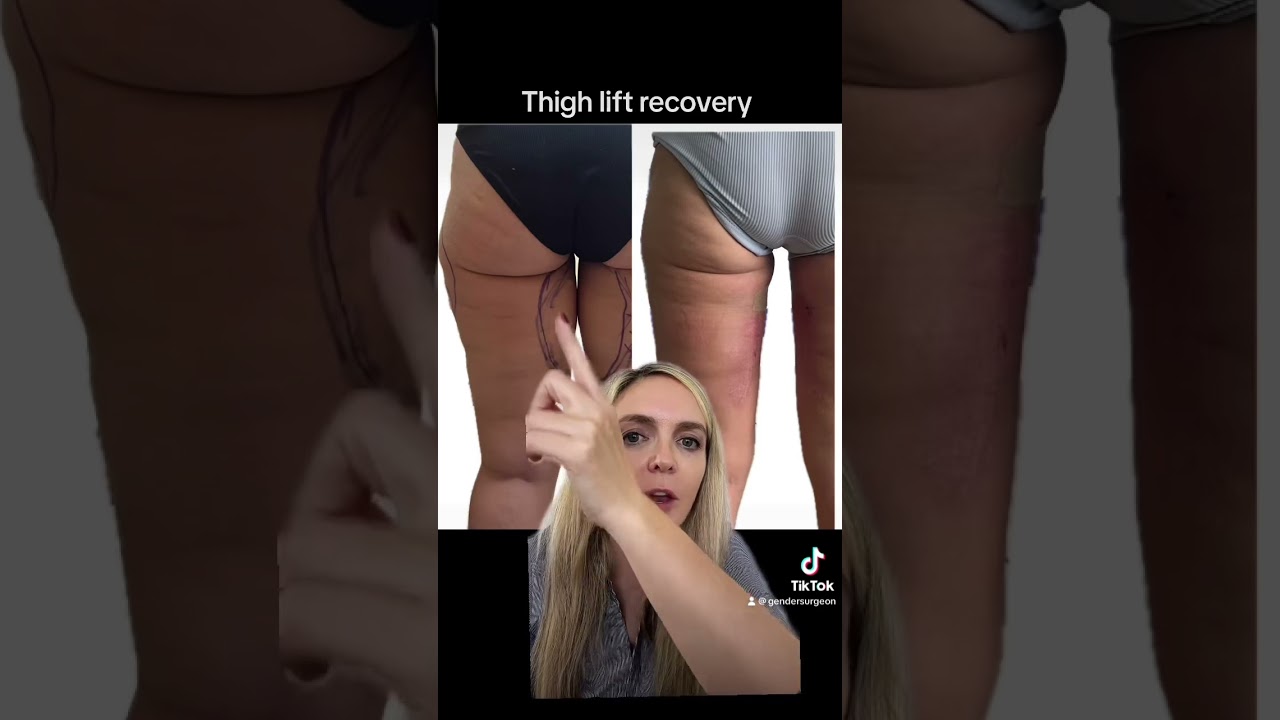 Thigh Lift Recovery 