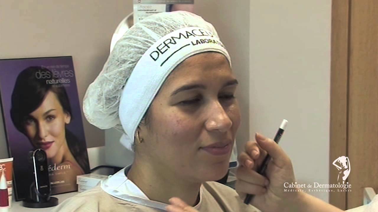 Toxine botulinique pour le haut visage