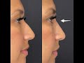Amazing nonsurgical nose job by dr tsay  ageless md