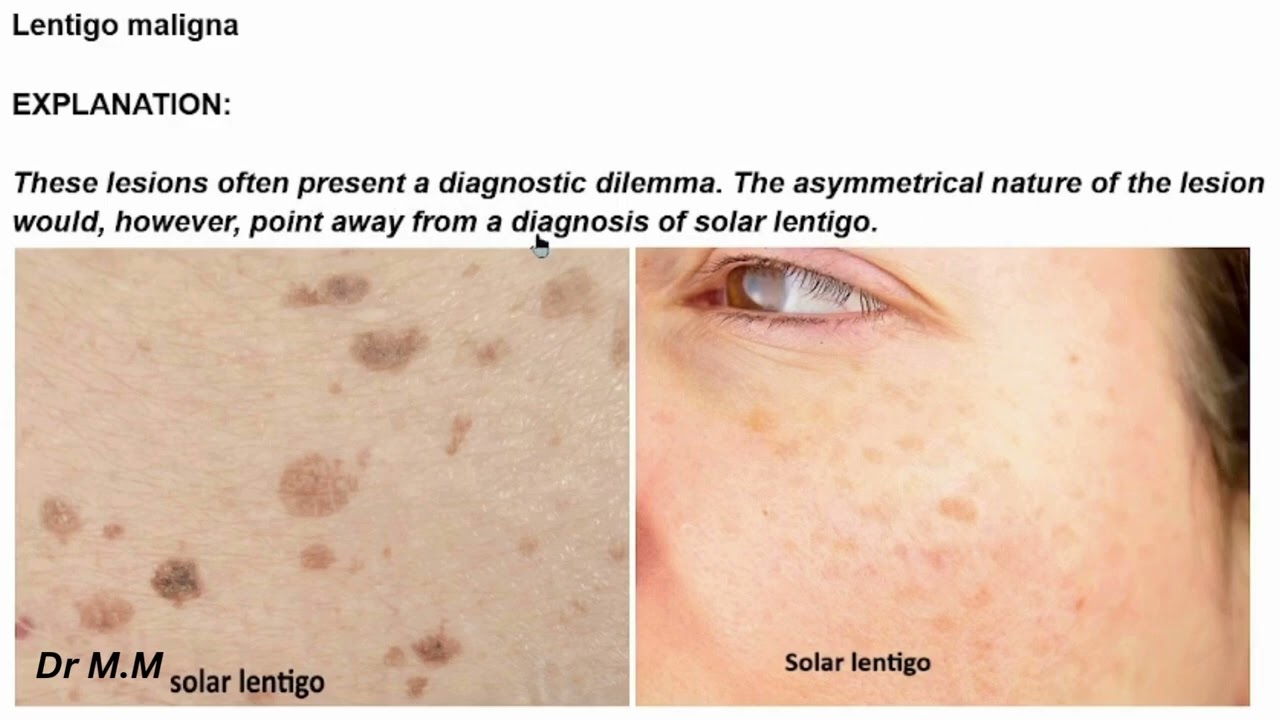 Lentigo Maligna: Early Melanoma Detection in Dermatology