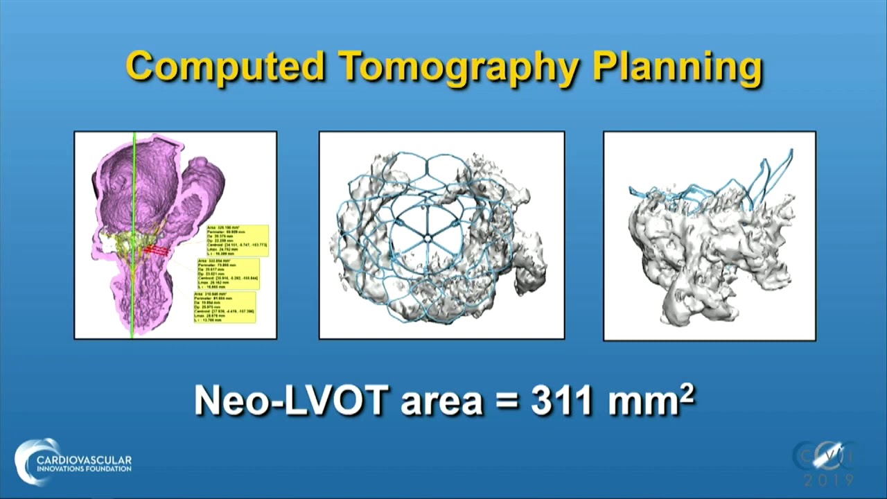 CVI 2019_Friday 7/19_ Innovations in Structural Heart Therapy_Paul Sorajja, MD video editing software free