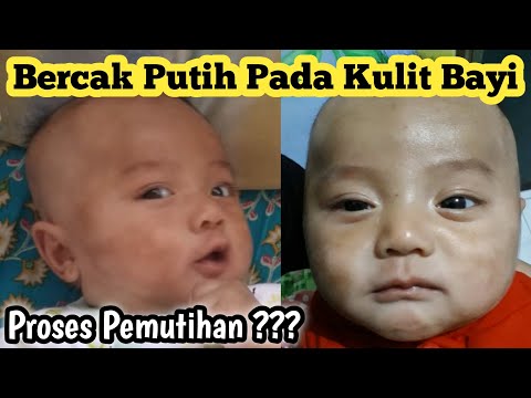 Video: Bolehkah kulit belang normal pada bayi?