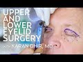 Upper and lower eyelid surgery blepharoplasty for seth  plastic with dr dhir