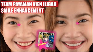 Zirconia Natural Looking Smile Enhancement with Vien Iligan of Team Payaman | Apostol Dental PH