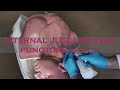 Пункція Внутрішньої яремної вени центральним доступом / Internal Jugular Vein puncture ENG subtitles