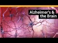 How alzheimers changes the brain