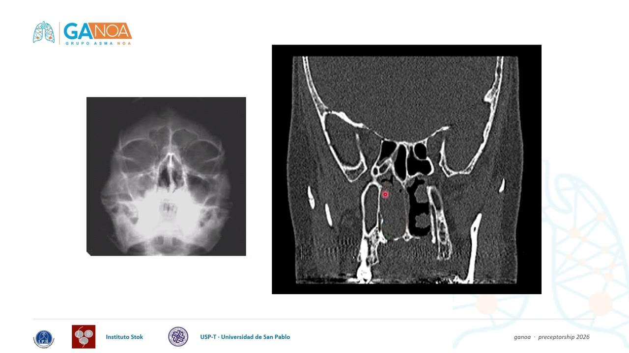 IMAGENES EN SINUSITIS