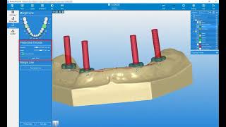 RealGUIDE Reconstruction Setup Overdenture, Scan Abutment Bar with Library Support for Locator