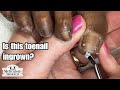 Ingrown Toenail Pedicure at Home Tutorial: Beauty 101