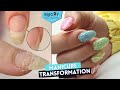 Manicure Transformation, Onycholysis? | Summer Manicure