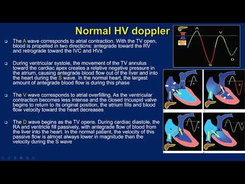 Hepatic vein doppler by Dr.  Jamiel A
