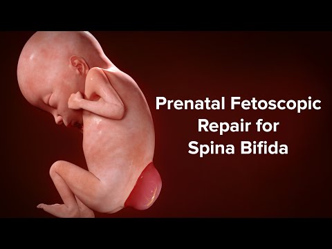 Prenatal Fetoscopic Repair for Spina Bifida | Cincinnati Children’s Fetal Care Center