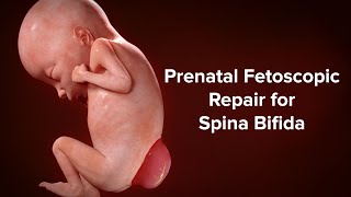 Prenatal Fetoscopic Repair for Spina Bifida | Cincinnati Children’s Fetal Care Center