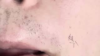 【INGROWN HAIR REMOVAL】ひたすら髭抜き PART403