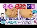 金の部屋【クレーターニキビ肌卒業】皮膚科治療・内服薬で改善できた方法を医師が解説【アクネ菌対策治療＆ピーリング＆保湿】西川礼華医師