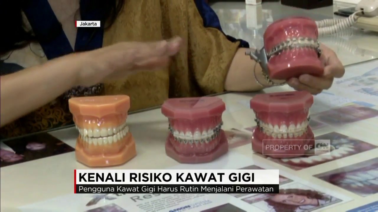 Kenali Resiko Kawat Gigi Anda