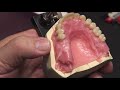 Setting Mondial Teeth: Ch. 2 - Set up