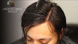 Premium Lace Hair Patch | Full Information About Frontlace Hair System | New Hair Image