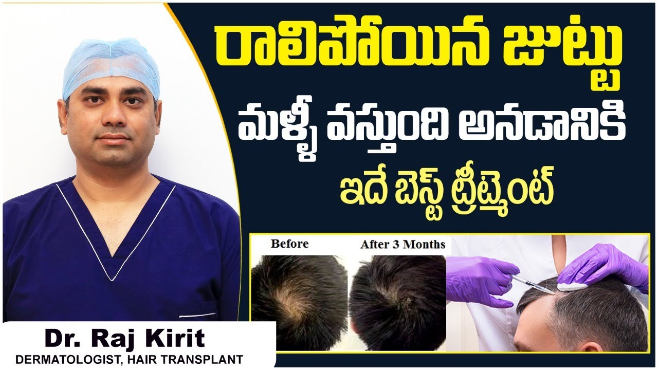 బట్టతలకు బెస్ట్ ట్రీట్మెంట్ | GFC Hair Treatment for Baldness Telugu | Celestee Skin And Hair Clinic