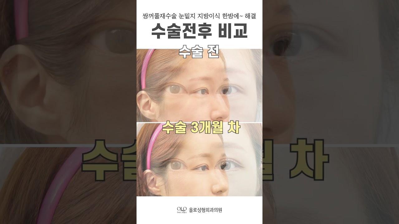 [OLLO Plastic Surgery] #phauthuatthammymimat_lan2 #laymotduoimimat #caymo #giaiquyethetmoi_trongmotlan_taiOLLO! #de_dep_tu_nhien_khong_lo_dau_vet~ #OLLOPlasticSurgery_cohet_ne~ #shorts