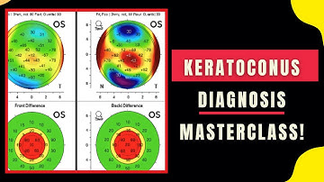 Keratoconus Diagnosis Masterclass 🔍