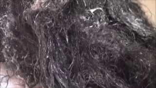 Hair Restoration محترفي إستعادة الشعر Youtube