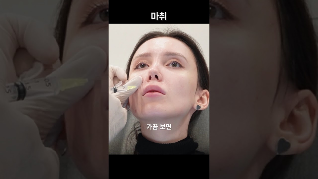 [Бьюти Блоссом эмнэлэг] Хамар амны үрчлээсгүй, залуу харагдах нууц 💫 Гадаадынхан ч сонгосон байгалийн харагдах филлер