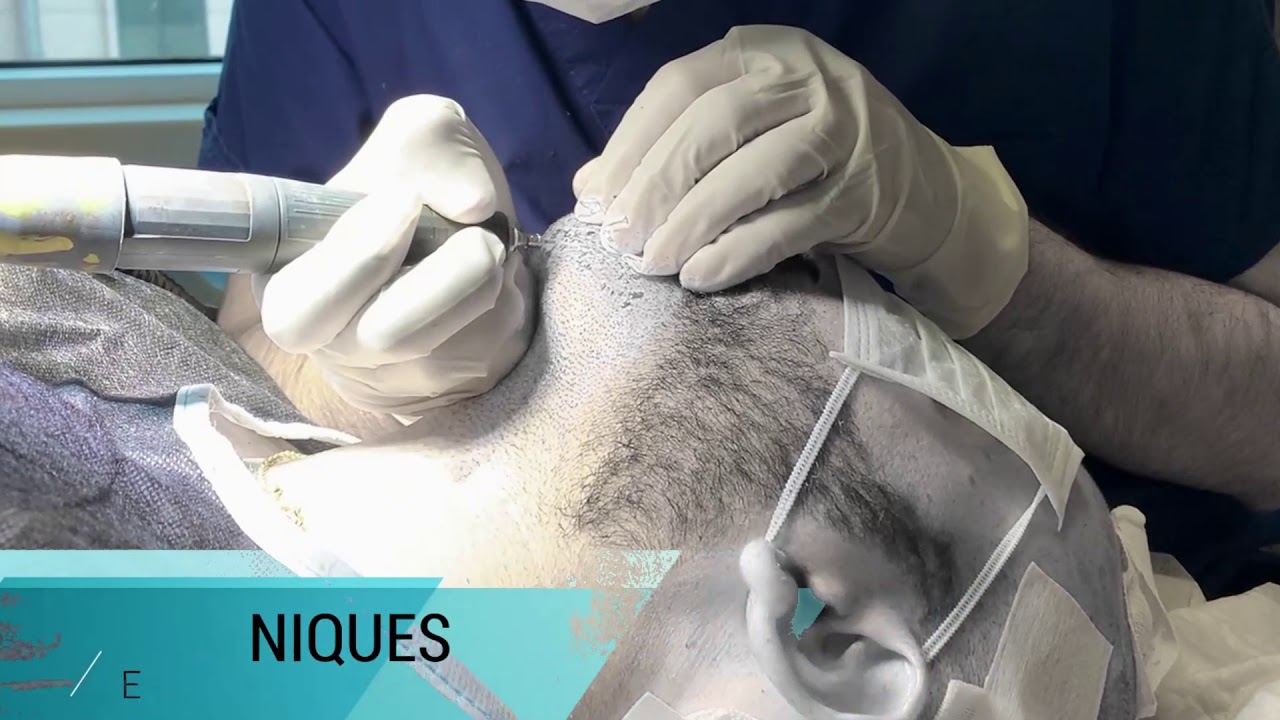 Beard Donor Areas - We are using Beard Donor Areas for more Graft