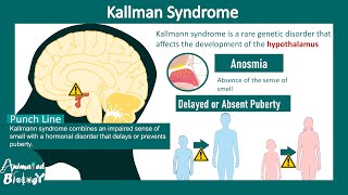 Kallman syndrome | Cause and treatment of Kallman syndrome