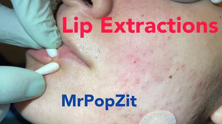 Lip extractions. Whiteheads, blackheads, acne extr...